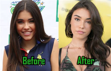 does madison beer have a boob job|Madison Beer: Before and After Surgery